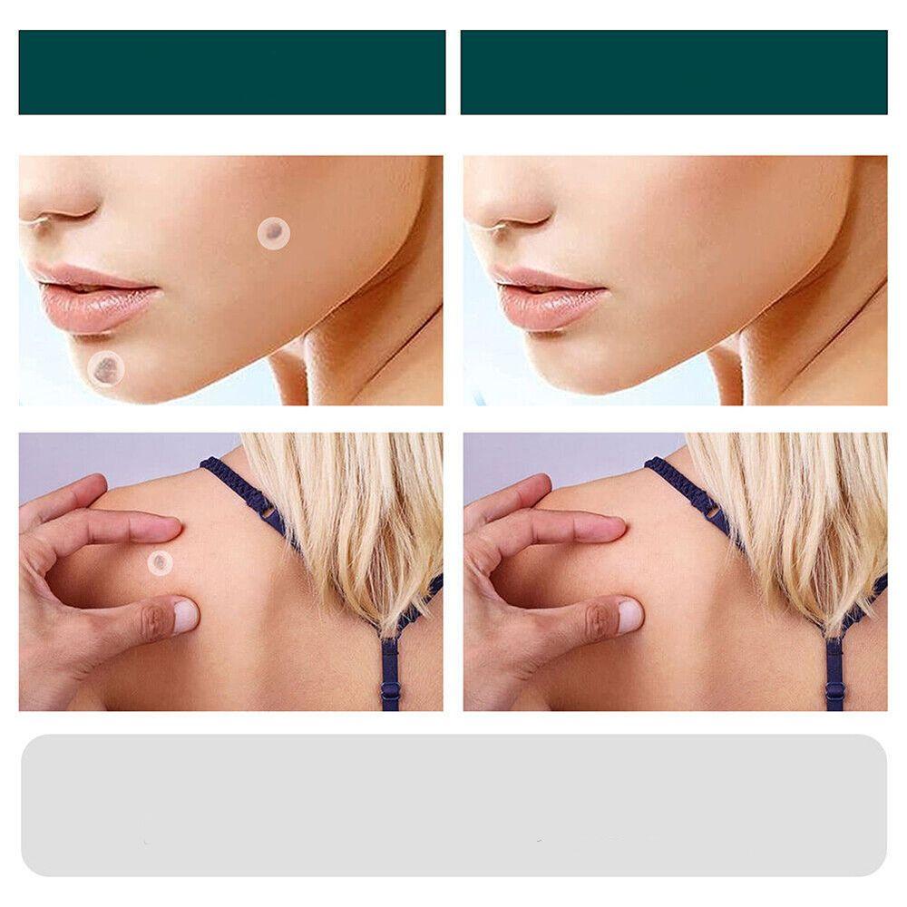 Patches pour élimination des taches cutanées et verrues avec hydrocolloïde – Indolore et discret – 120 pièces | Sulvida