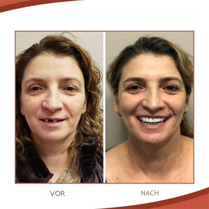 Set de Prothèse Dentaire Biocompatible – Prothèse Facilement Ajustable pour un Sourire Naturel et Confortable | Sulvida