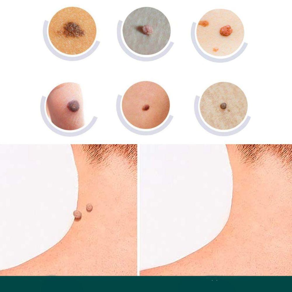 Patches pour élimination des taches cutanées et verrues avec hydrocolloïde – Indolore et discret – 120 pièces | Sulvida