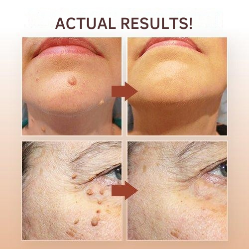 Détachant pour verrues et taches cutanées à base d’une formule végétale naturelle – Traitement indolore à domicile, sans cicatrices, pour une amélioration efficace de la peau | Sulvida